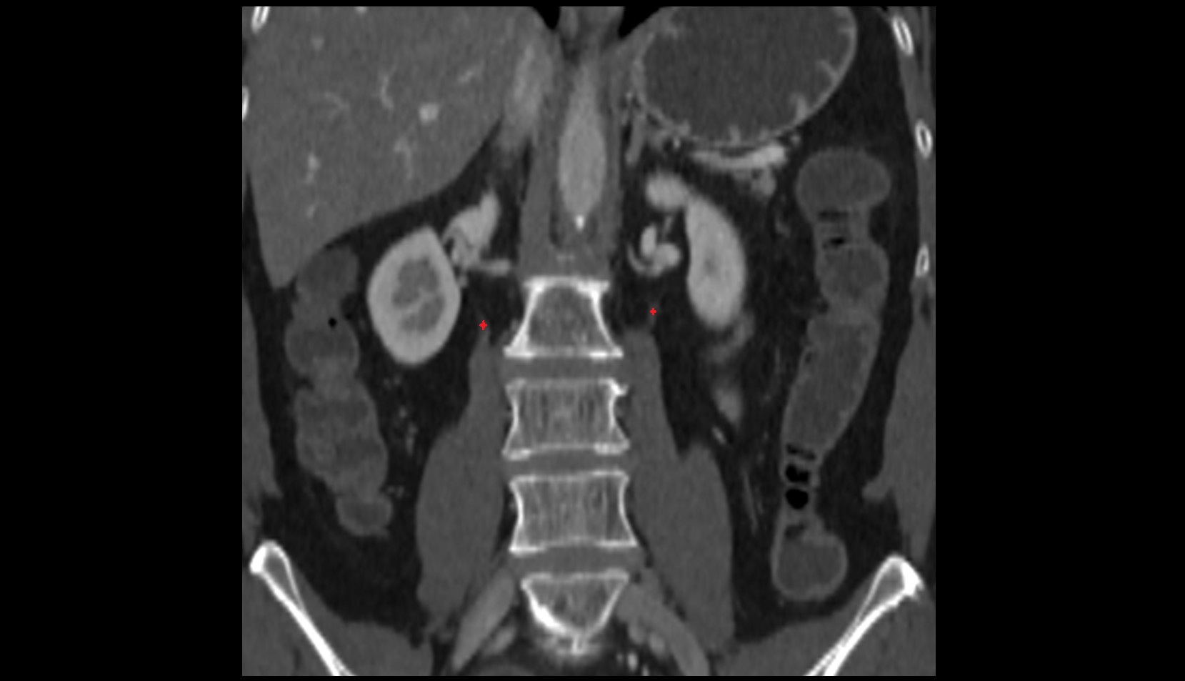 ureters  CT coronal image