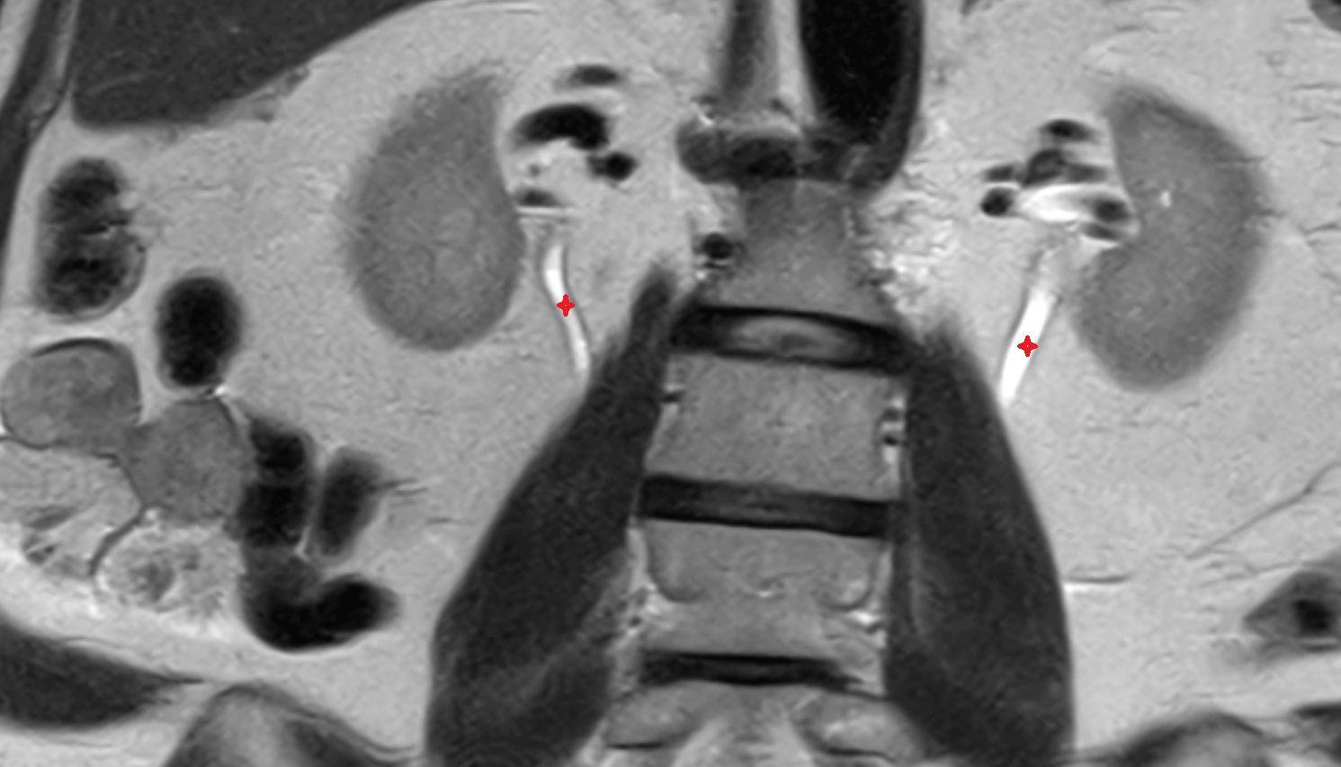 ureters  MRI coronal  image anatomy  image -img-00000-00000