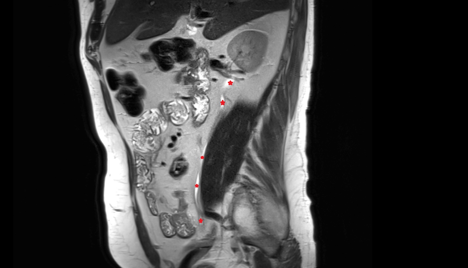 ureters  MRI sag  image anatomy  image -img-00000-00000_00001