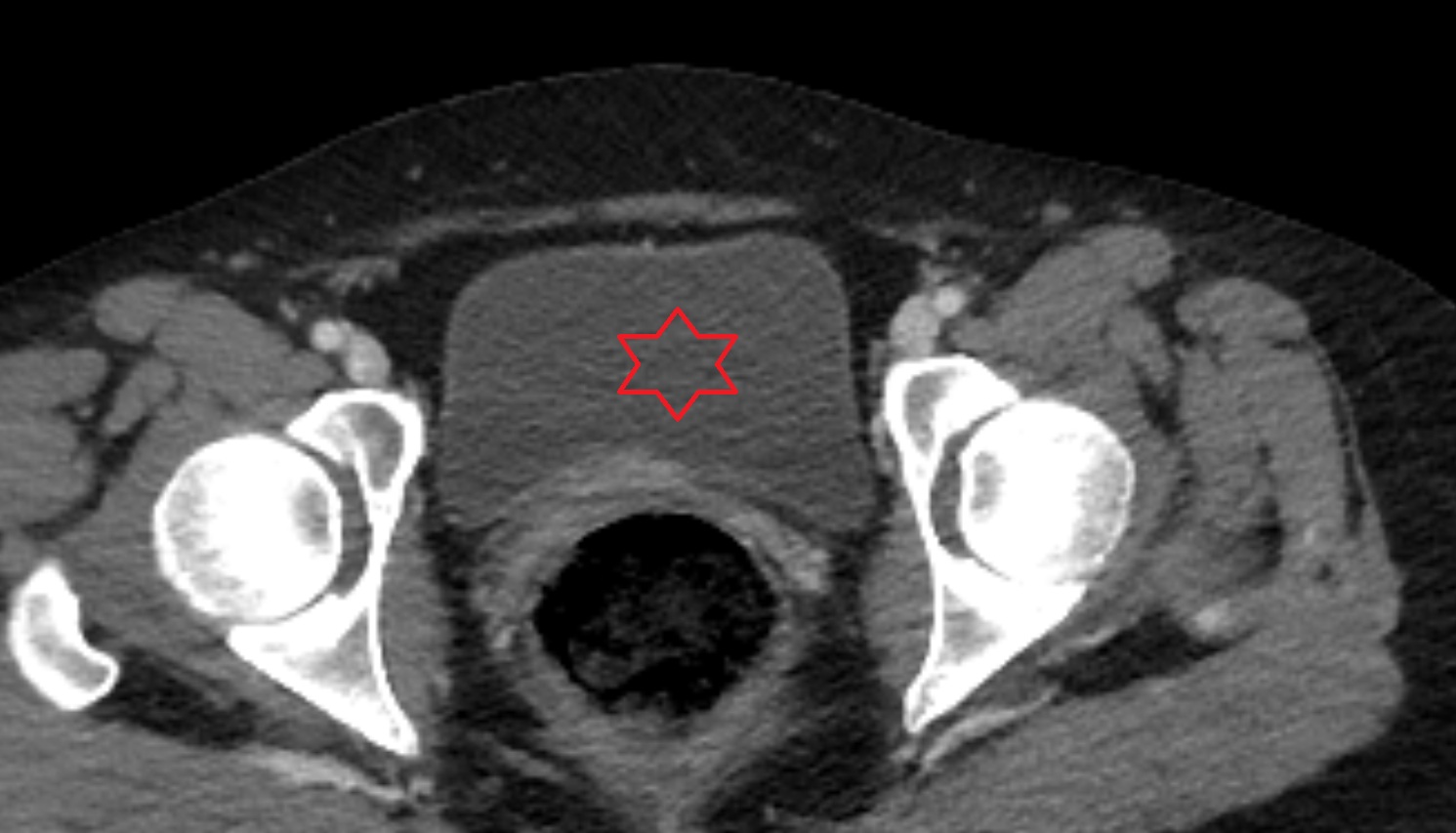 urinary bladder  ct axial  anatomy  image-img-00000-00000