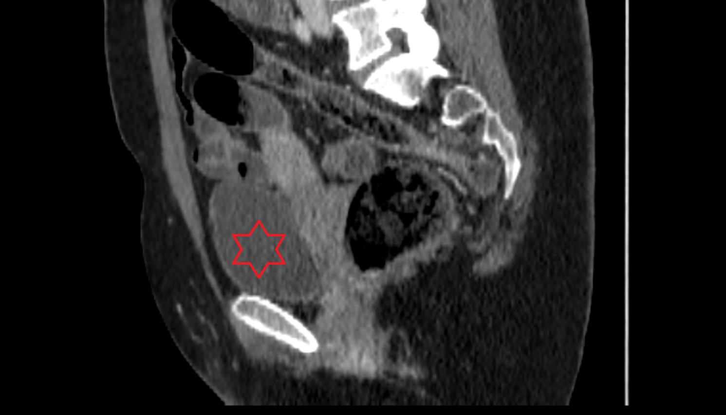 urinary bladder  ct  sagittal anatomy  image-img-00000-00000
