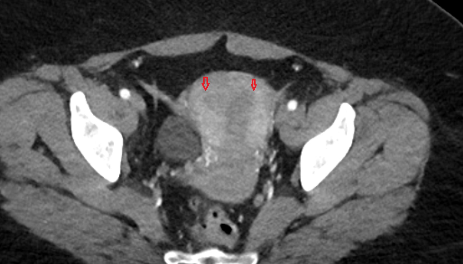 uterine horn  CT axial  anatomy  image-img-00000-00000
