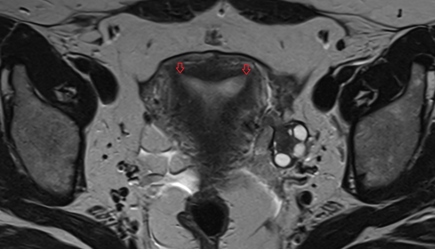 uterine horn   MRI  axial  anatomy  image-img-00000-00000
