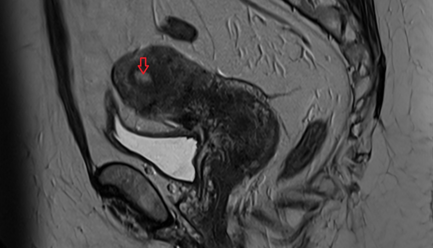 uterine horn   MRI  sagittal  anatomy  image-img-00000-00000