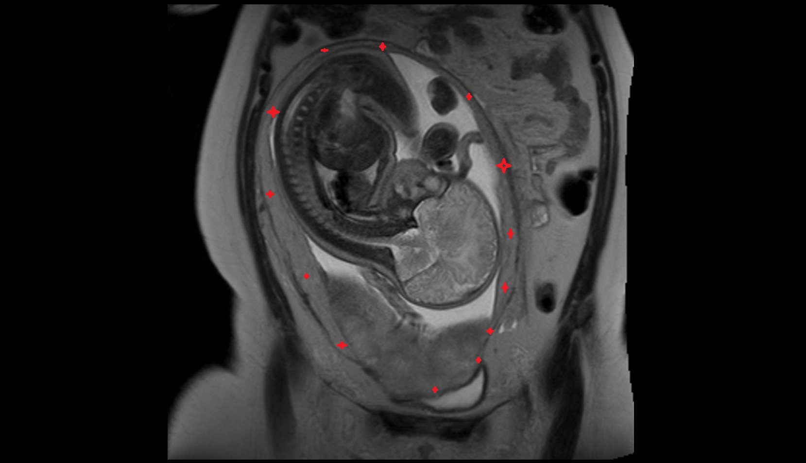 uterus  (pregnancy) MRI coronal image