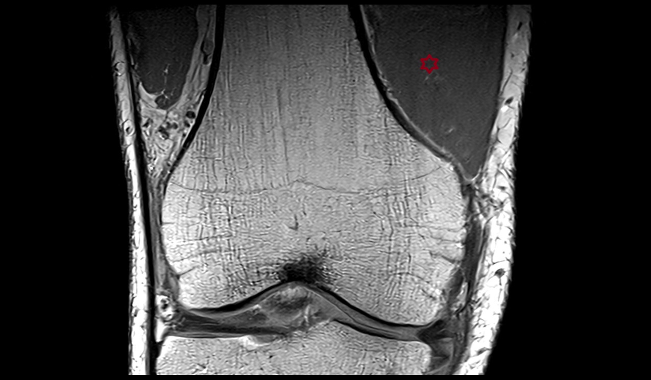vastus medialis muscle image
