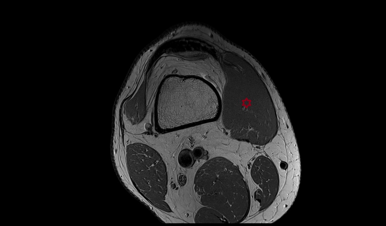 vastus medialis muscle mri axial image