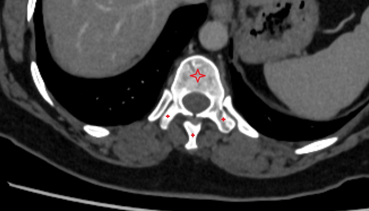 vertebrae  CT axial  anatomy  image-img-00000-00000