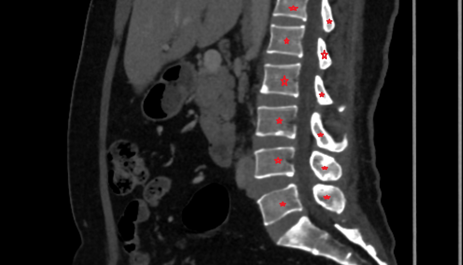 vertebrae  CT sagittal  anatomy  image-img-00000-00000