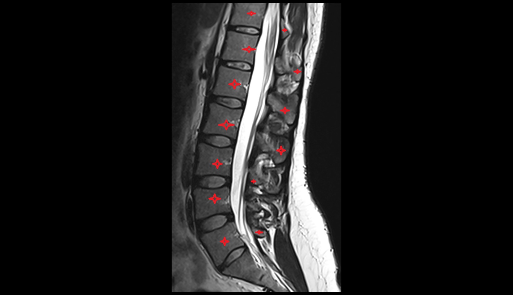 vertebrae MRI SAGITTAL IMAGE