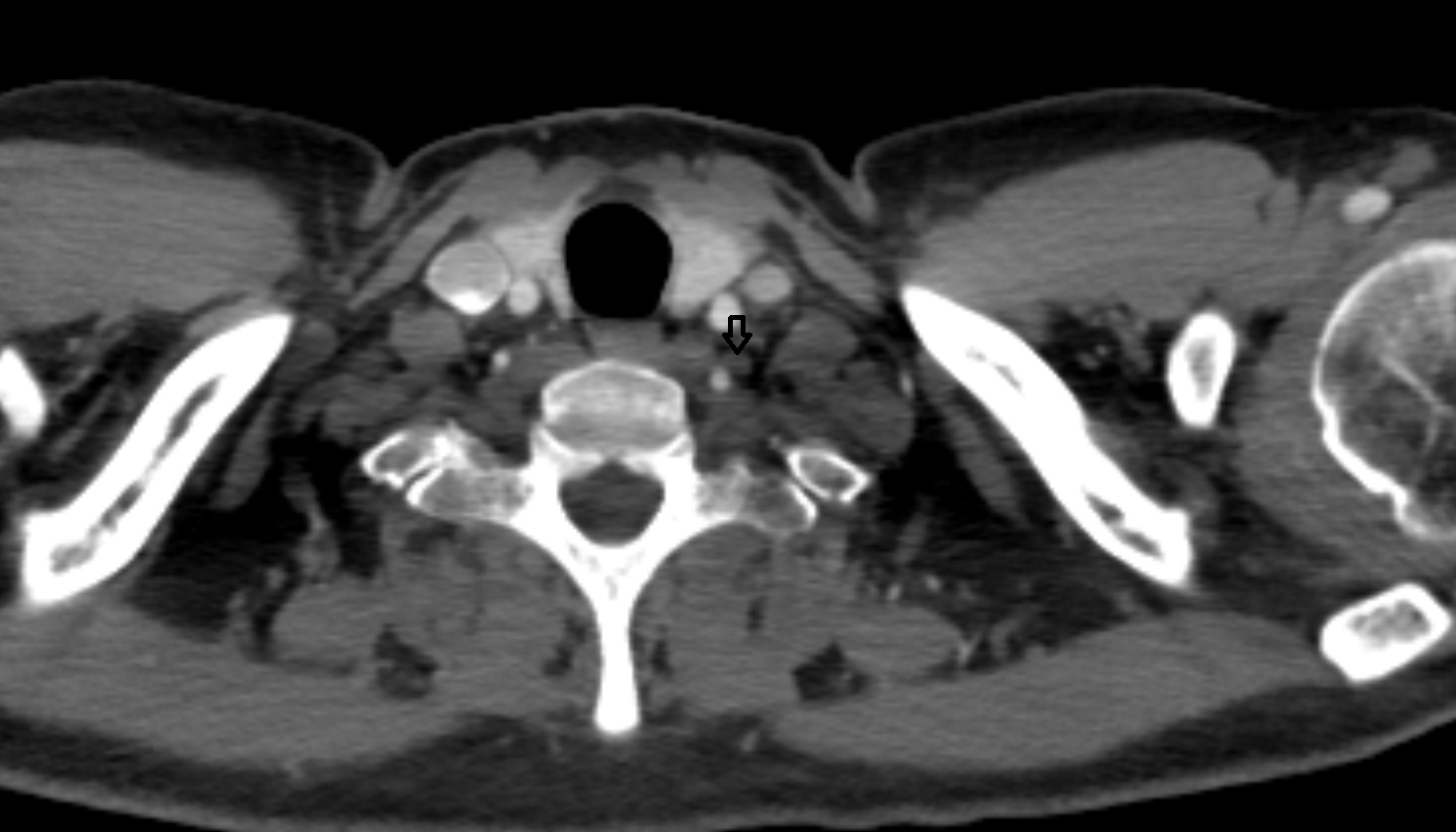 vertebral vein anatomy axial CT  image -img-00000-00000