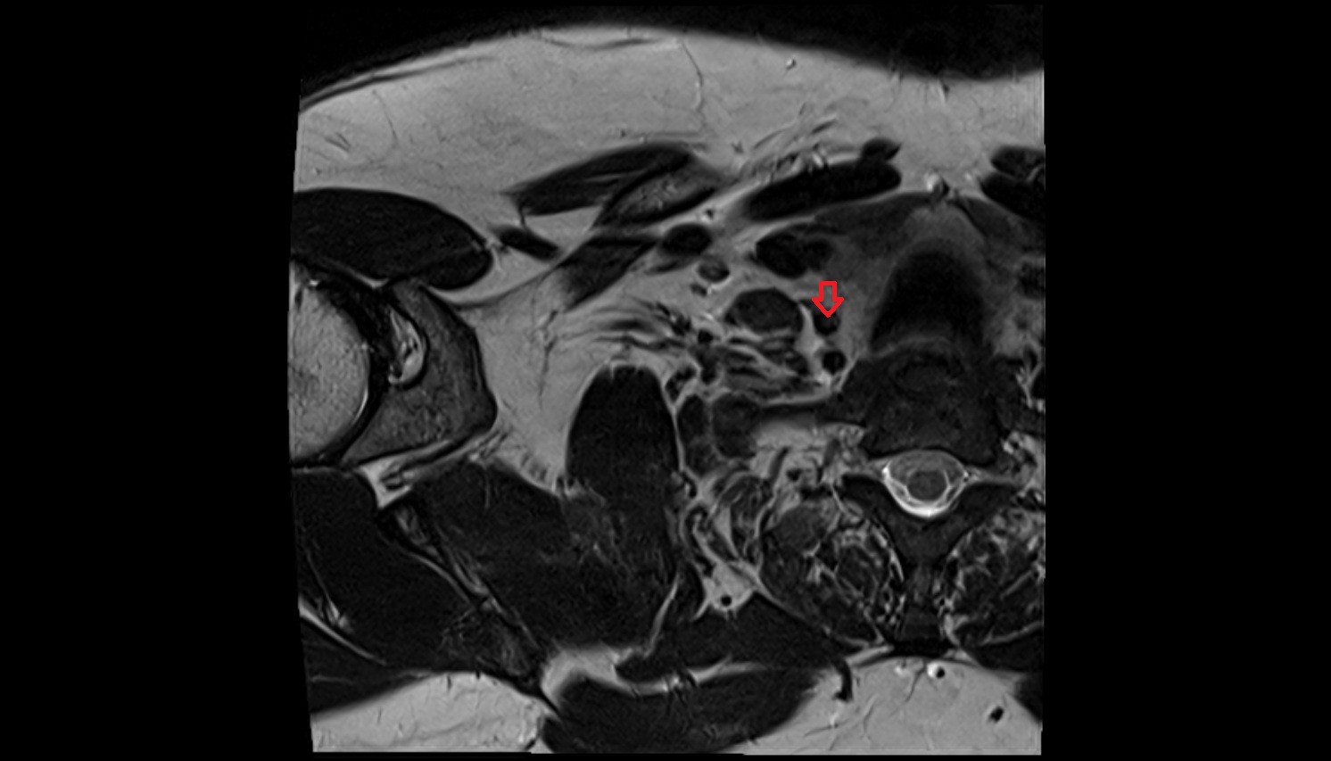 vertebral vein anatomy axial  MRI  image -img-00000-00000