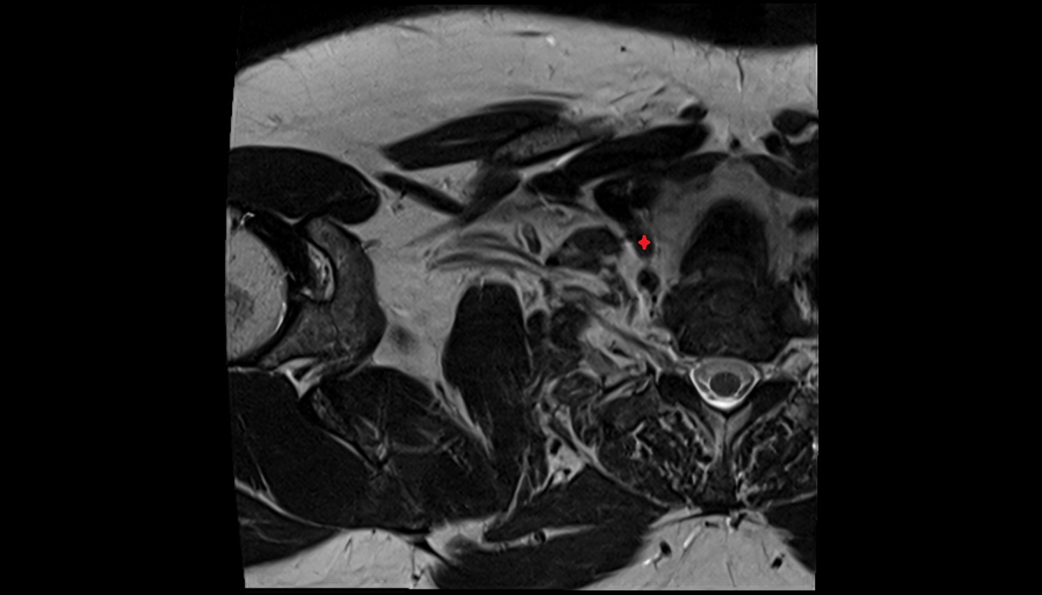 vertebral vein anatomy axial  MRI  image -img-00000-00000_00001