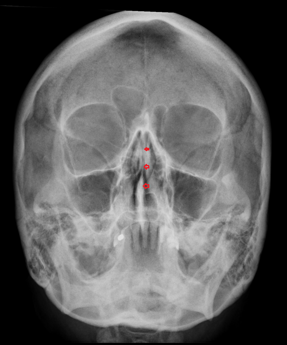 x ray Bony nasal septum
