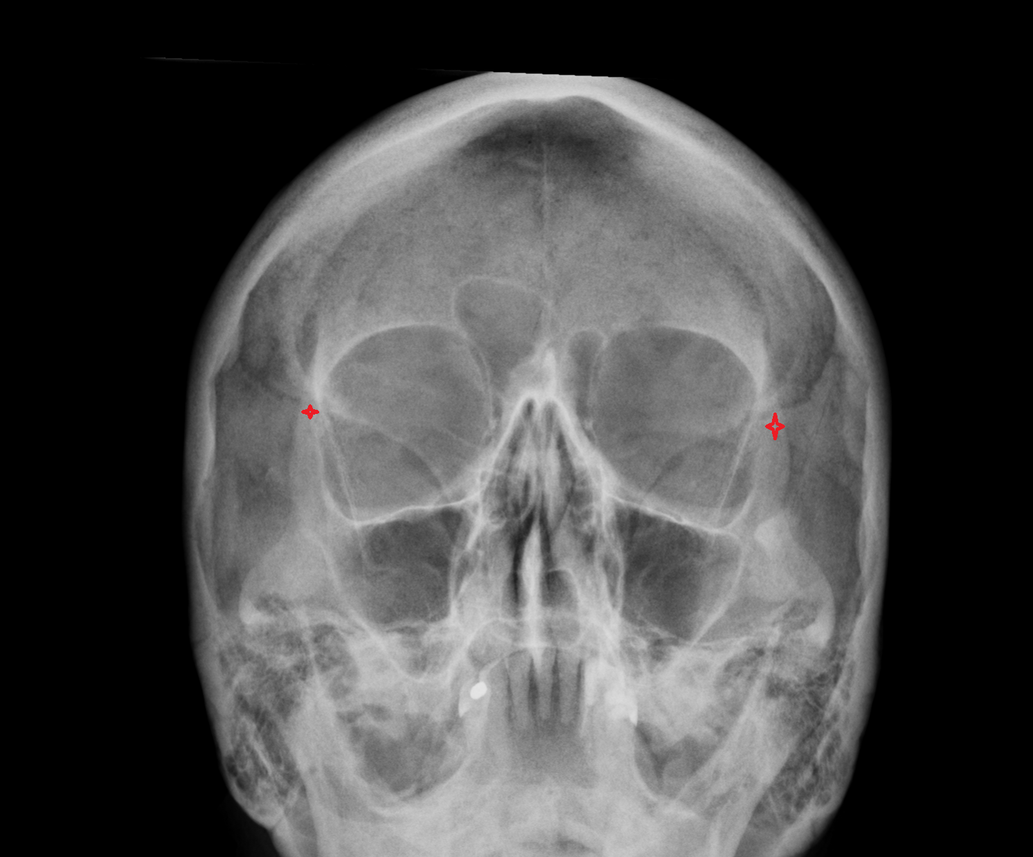 x ray Frontal process of zygomatic bone