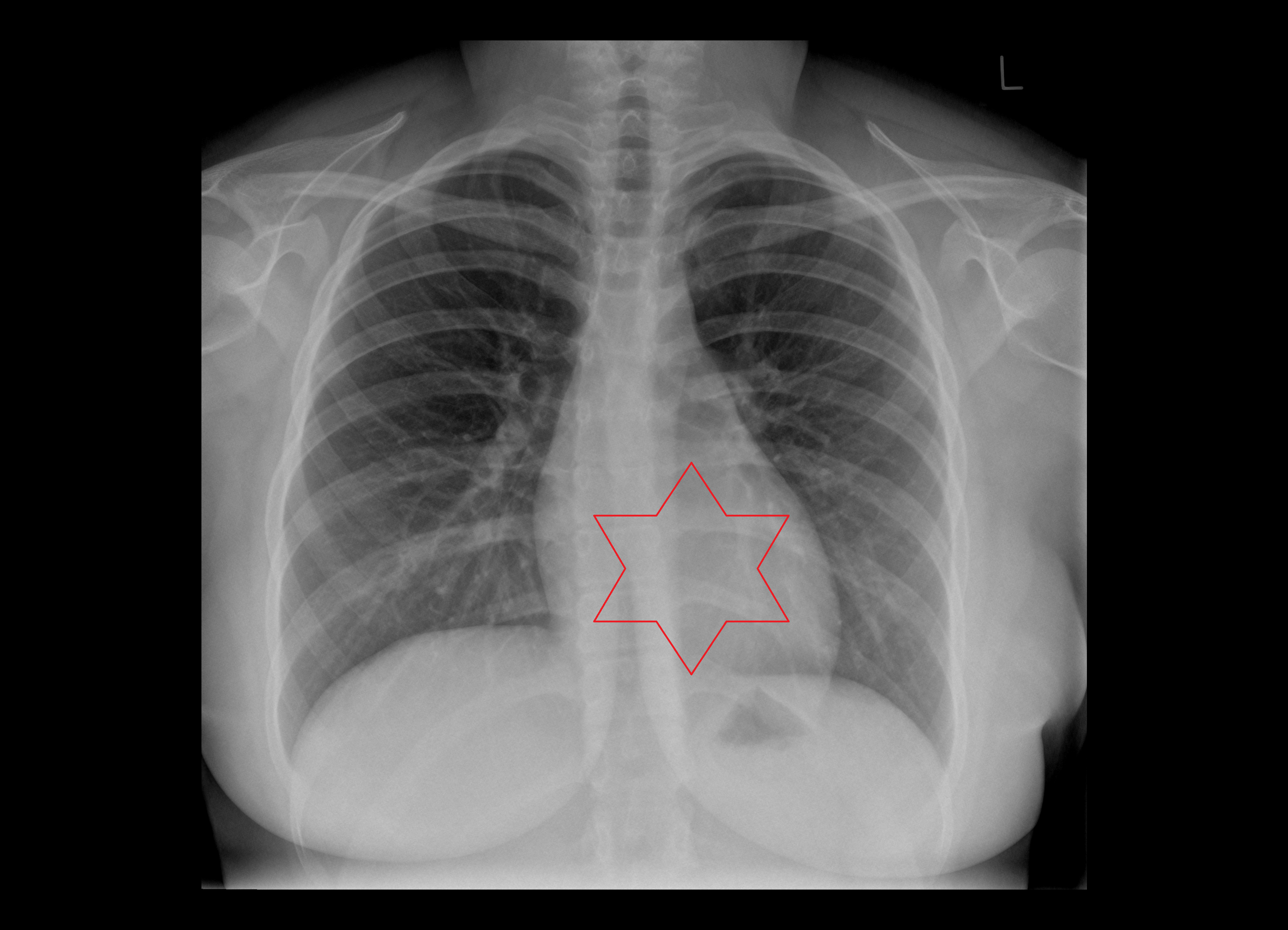 x ray Heart