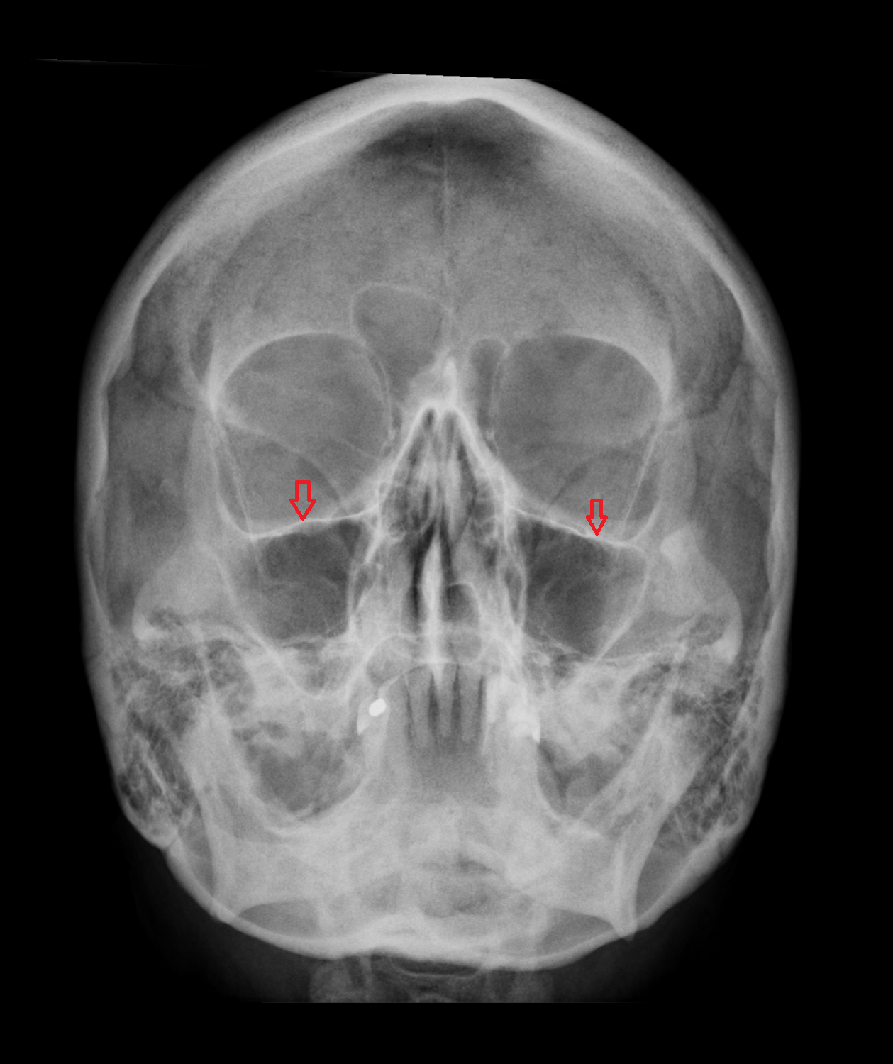 x ray Infraorbital margin