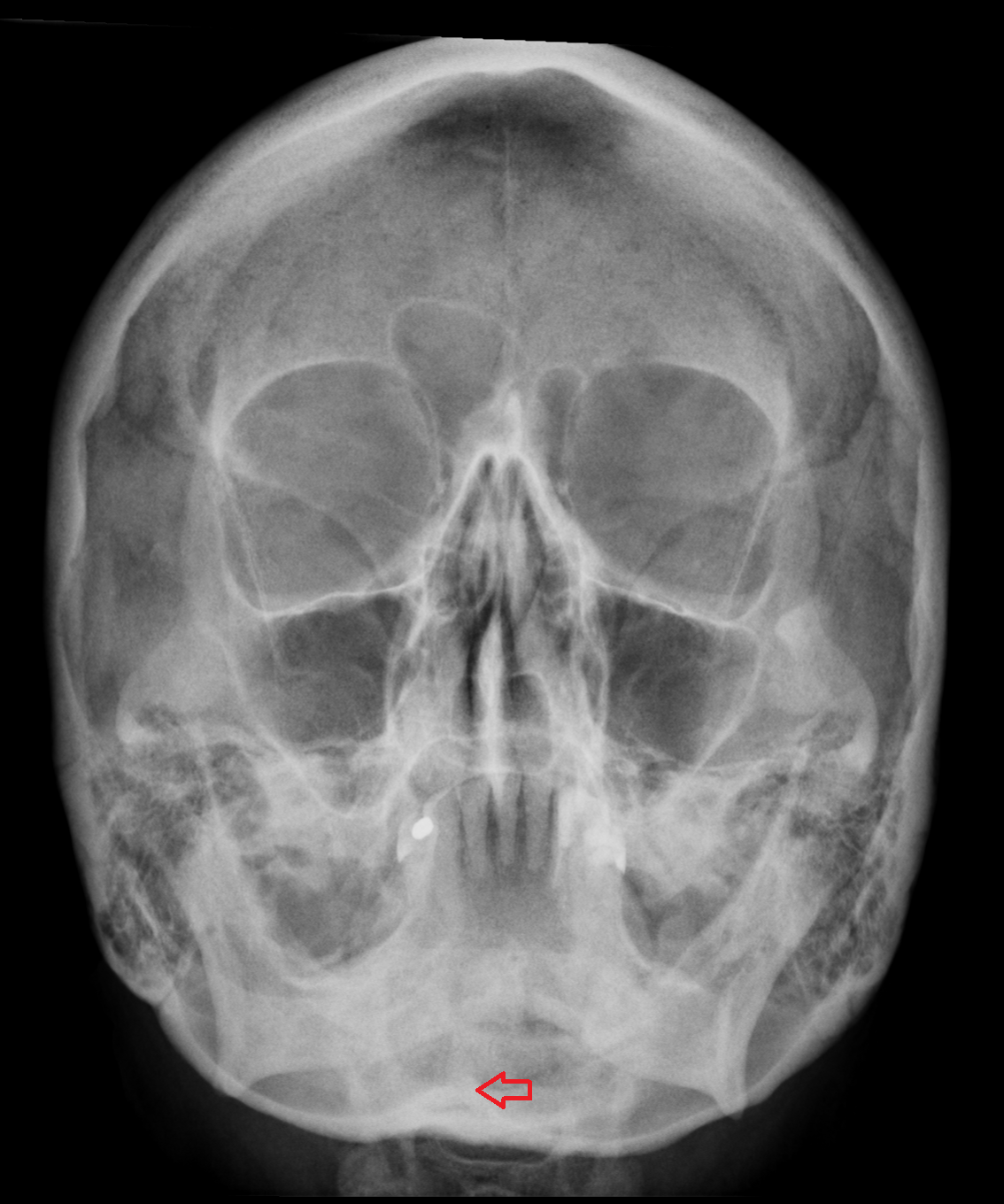 x ray Internal occipital crest