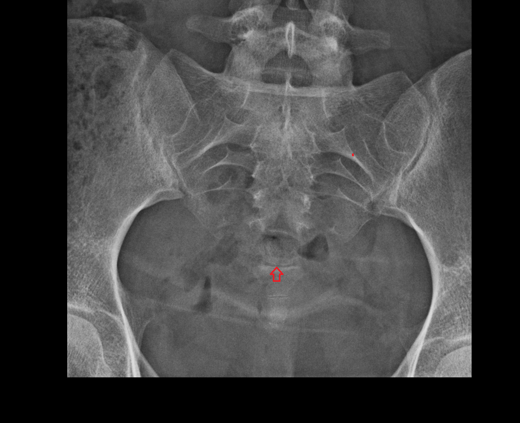 x ray L SpineAP-img-00000-00000 (1)