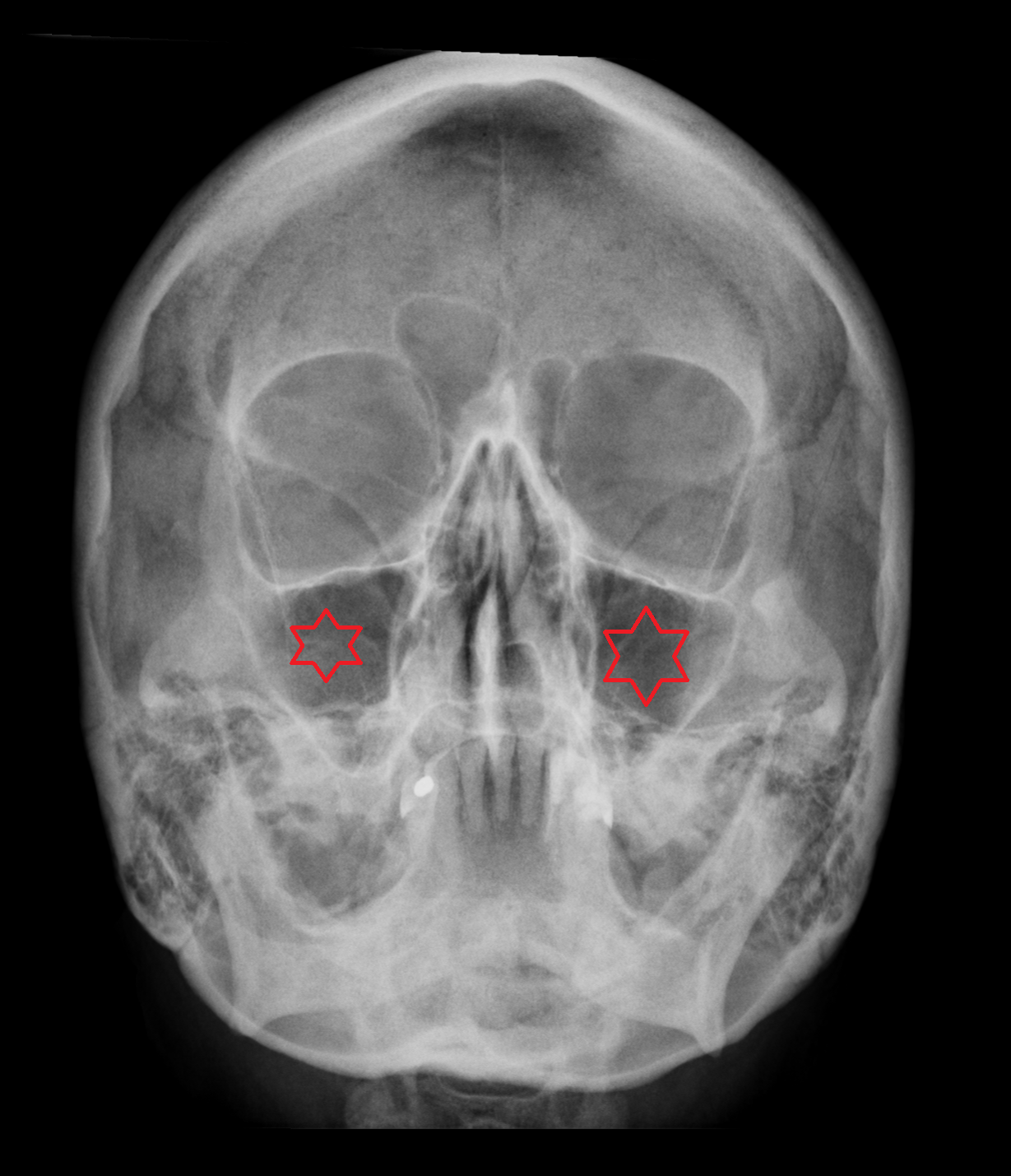 x ray Maxillary sinus