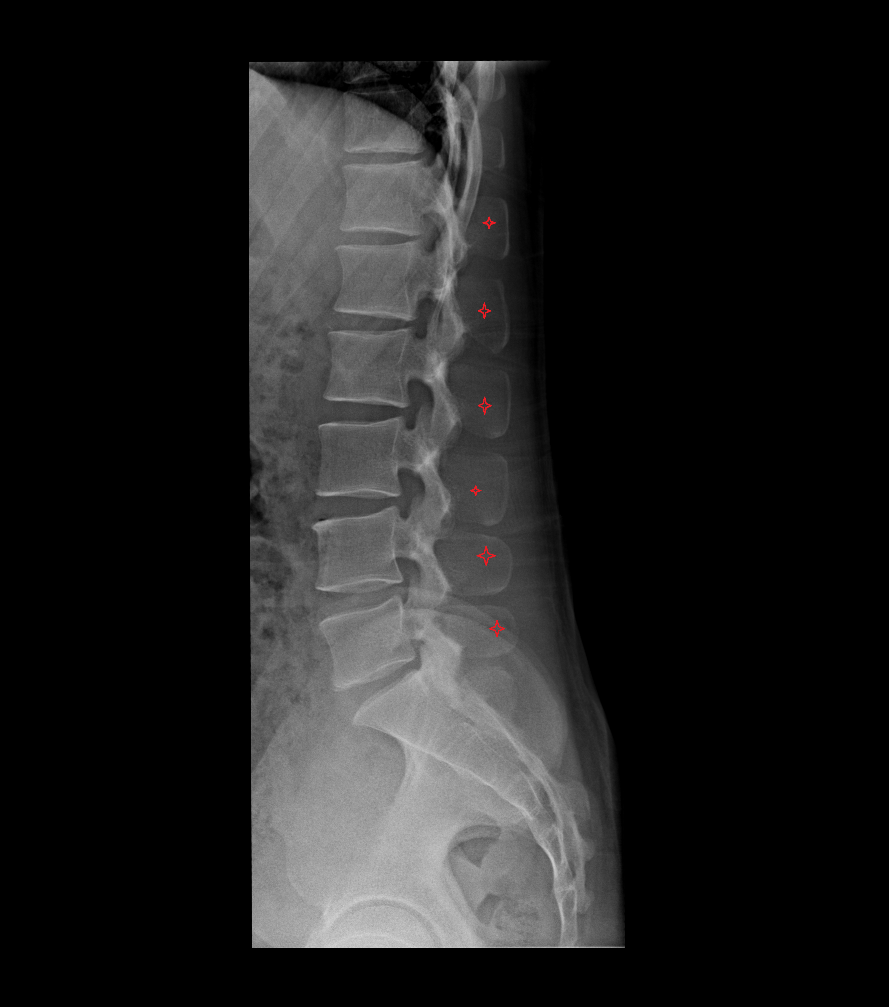 x ray Spinous process