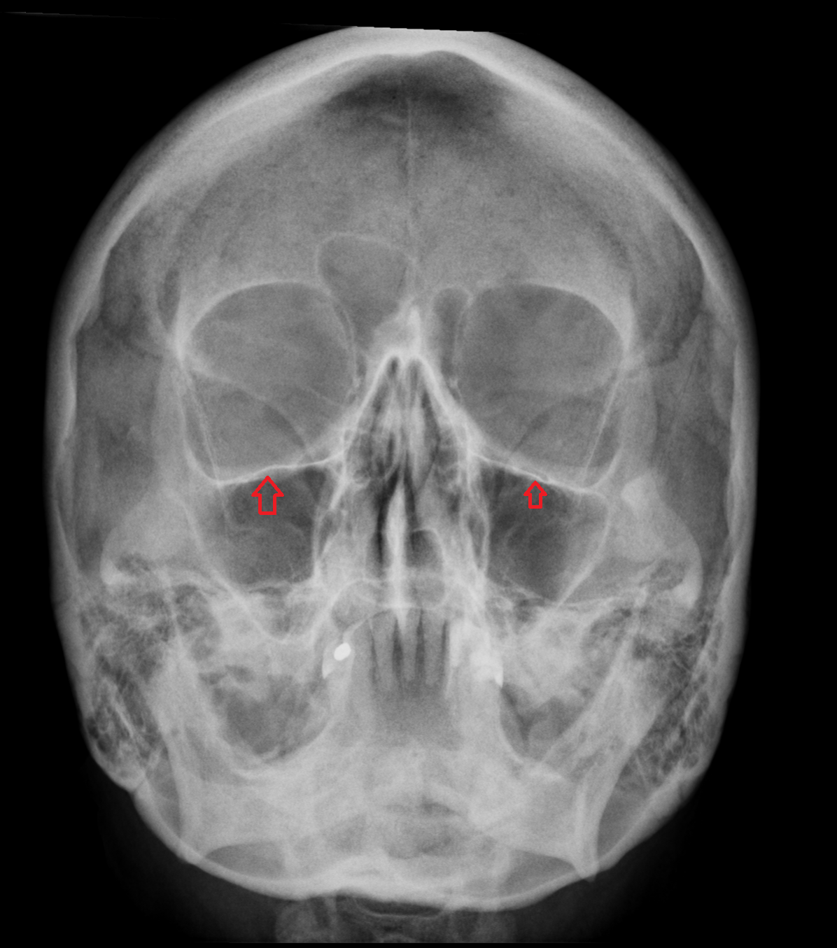 x ray Superior wall of maxillary sinus