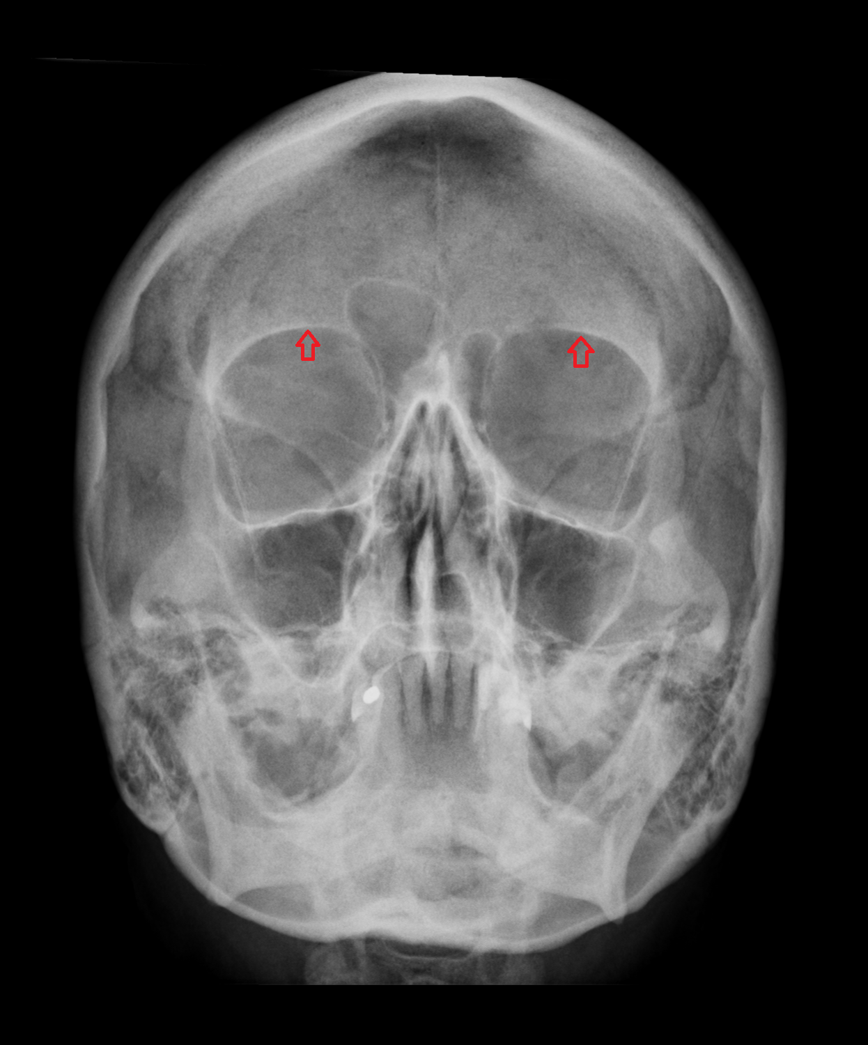 x ray Supraorbital margin