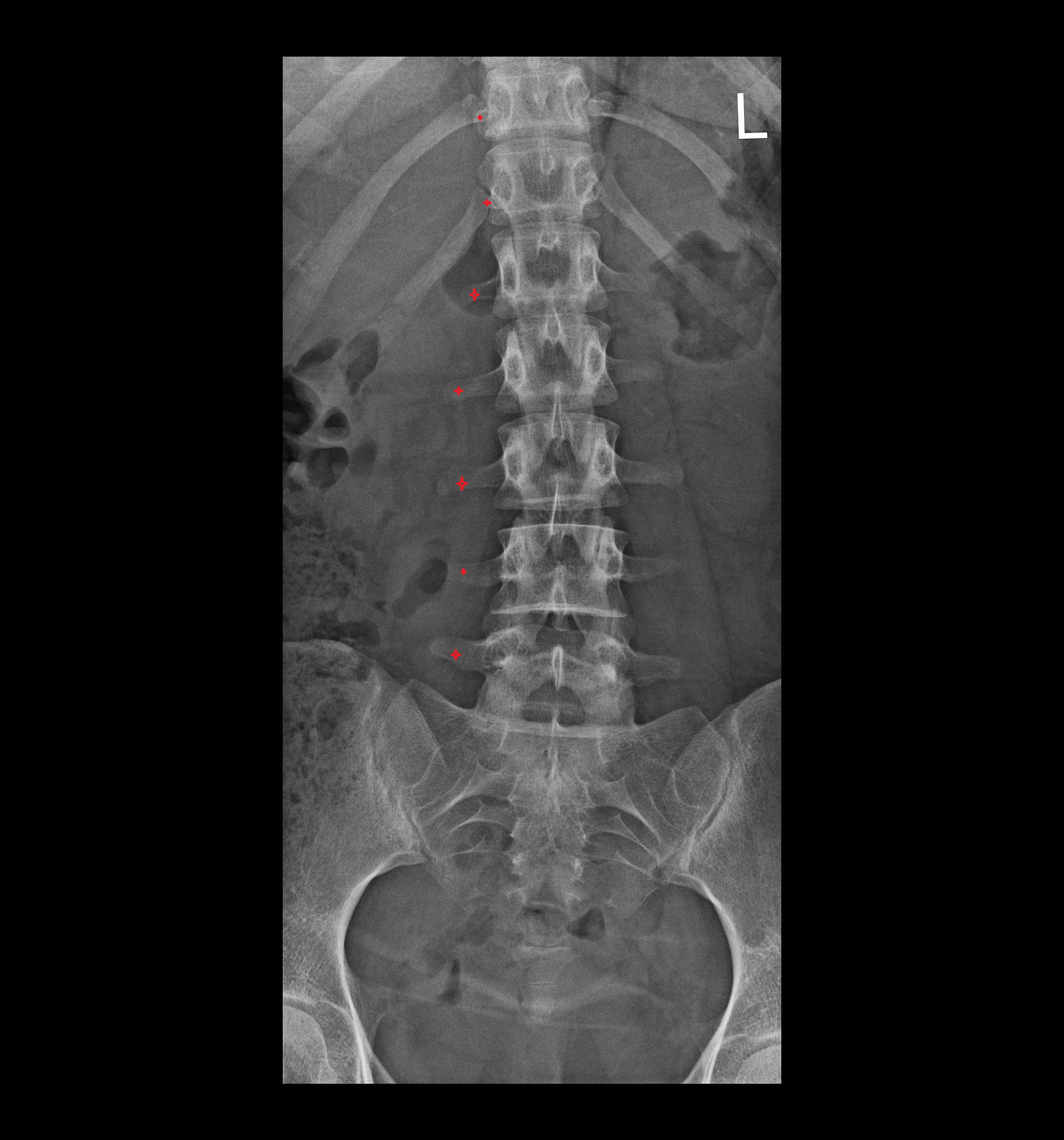 X ray Transverse process