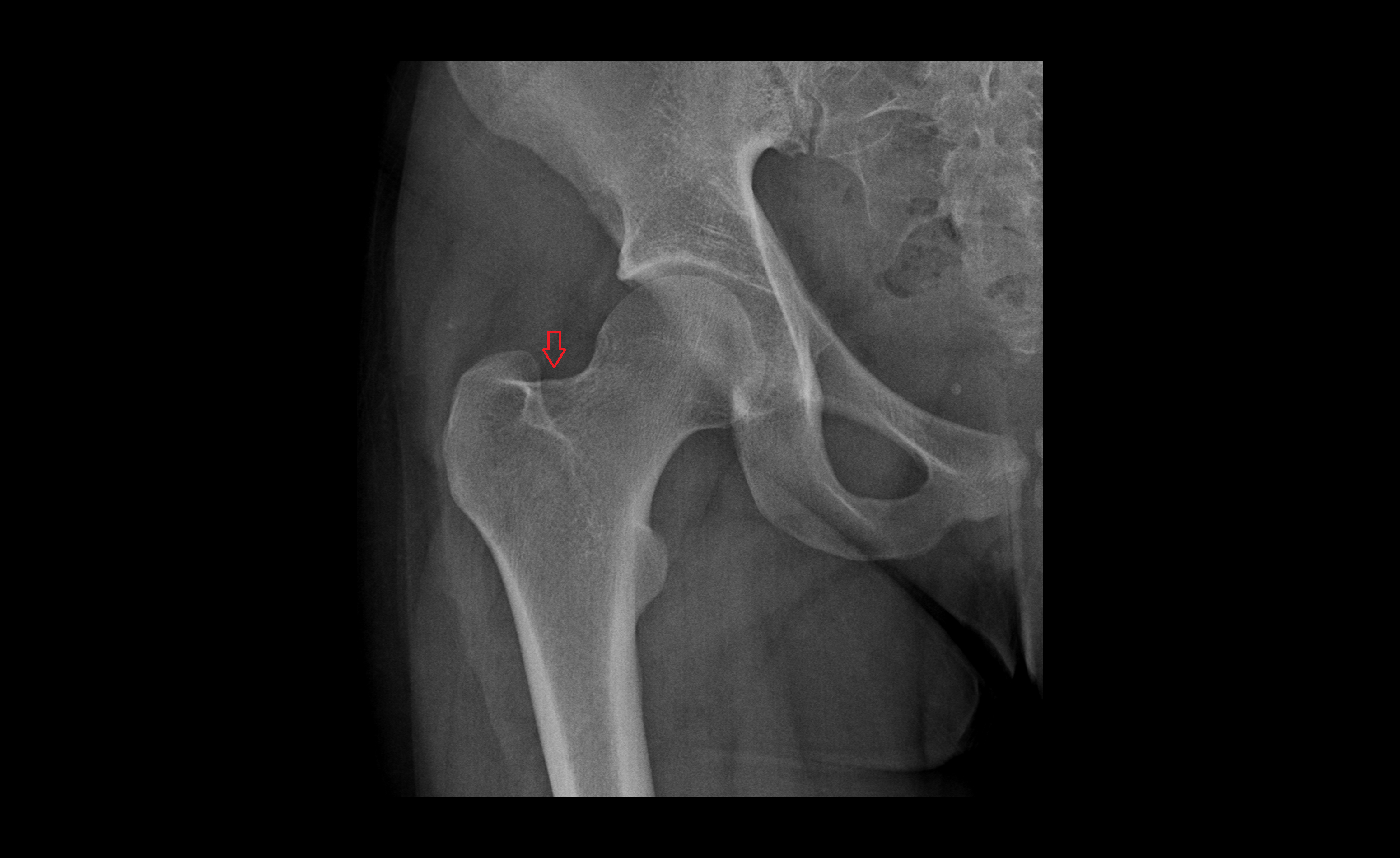 x ray Trochanteric fossa