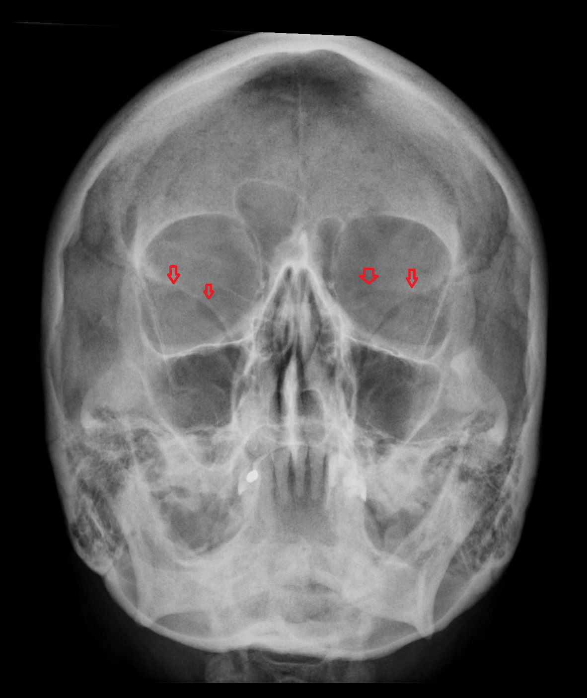 x ray facial bone - Copy (2)