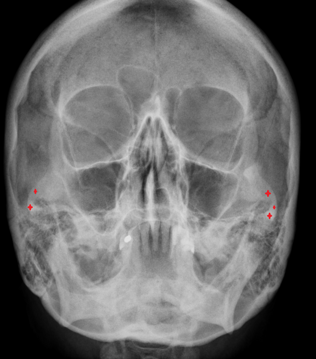 x ray facial bone  PA