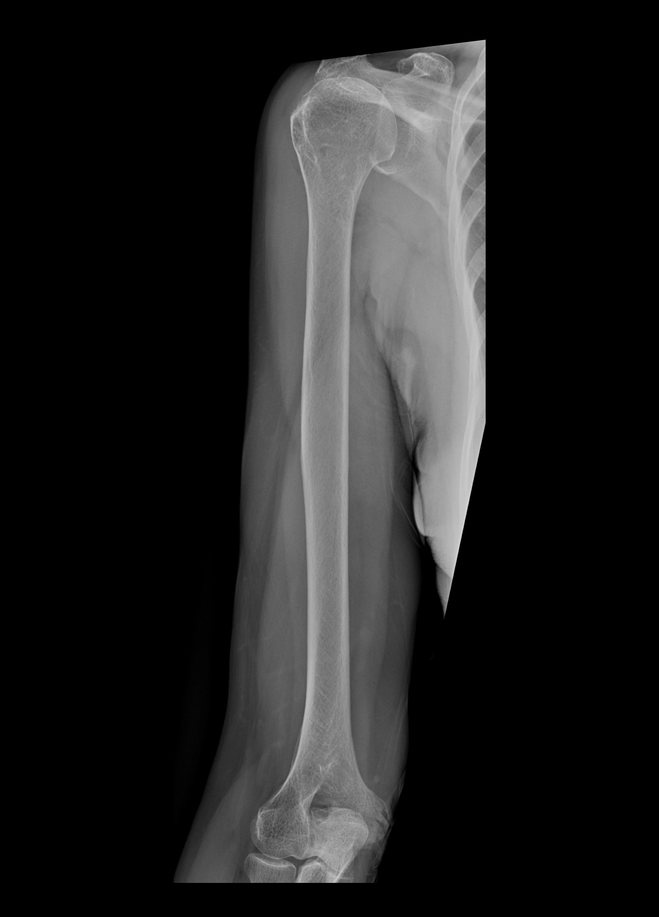 x ray  humerus  ap