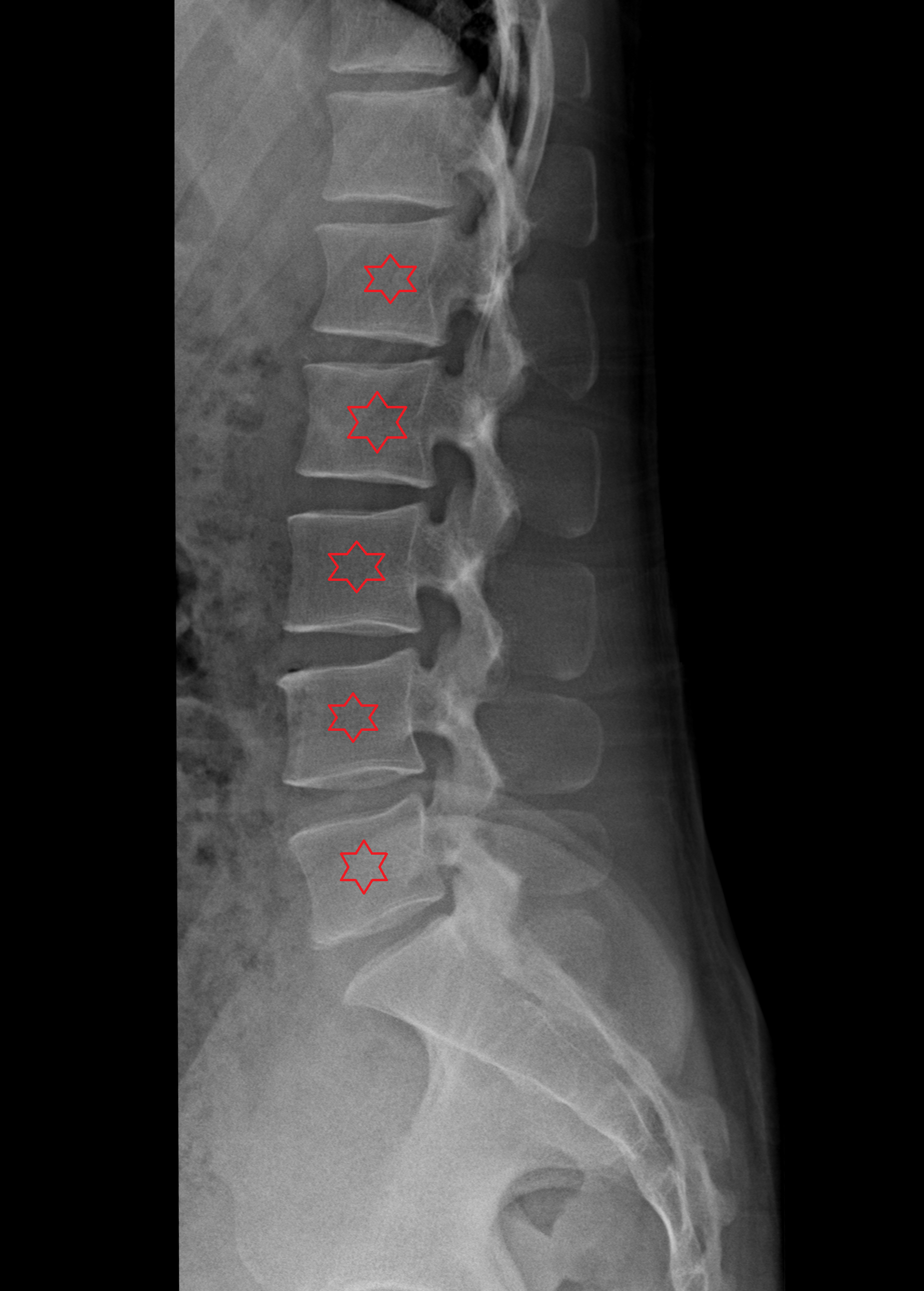 x ray l spine lat-img-00000-00000 (1)