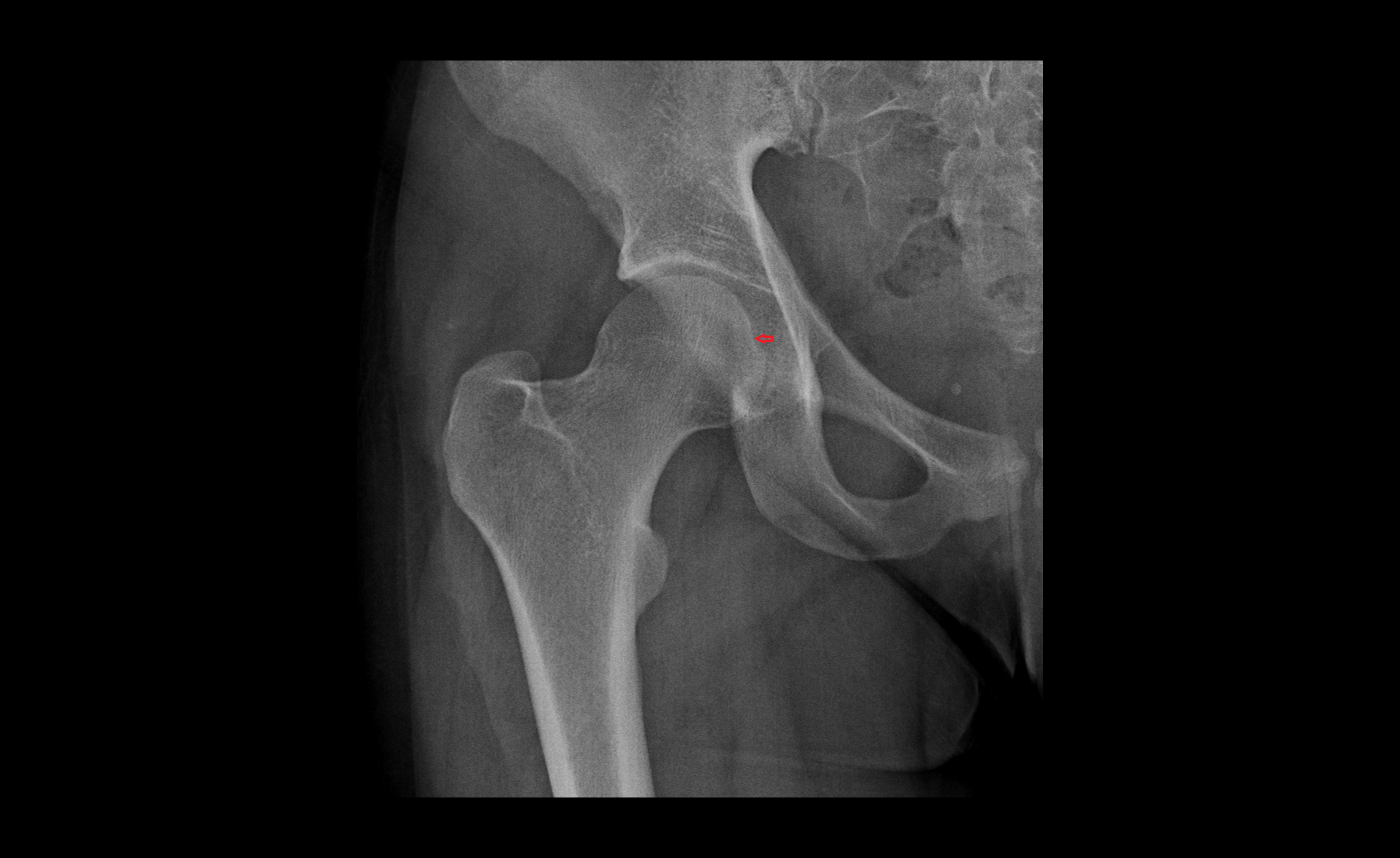 Fovea for ligament of head of femur