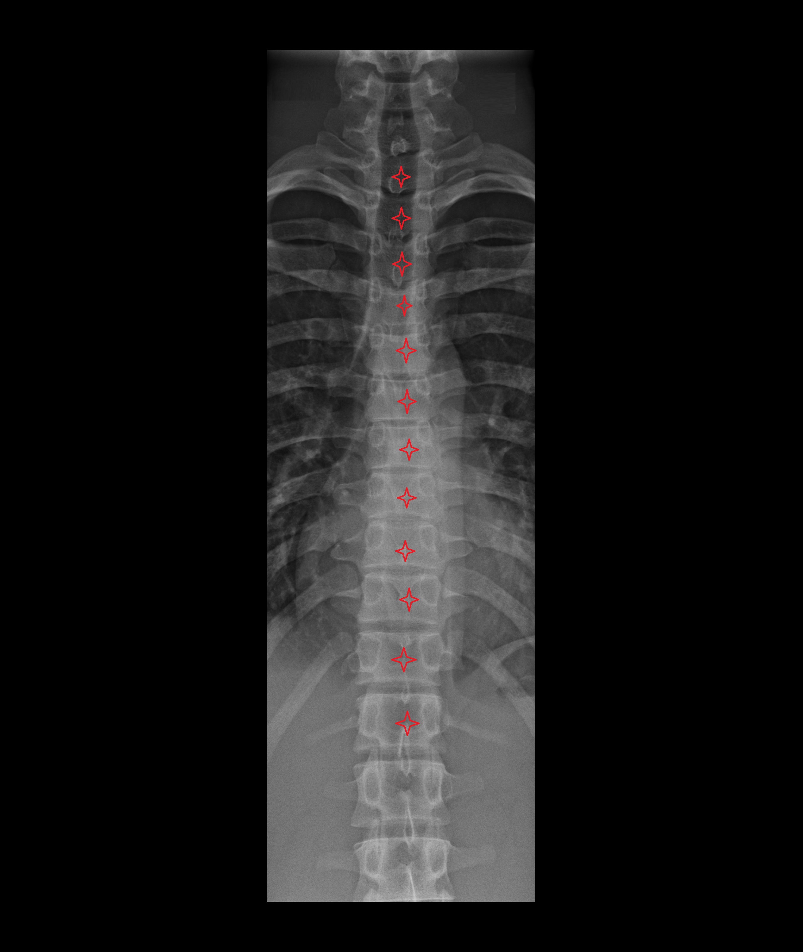 x ray t spine AP-img-00000-00000_00003