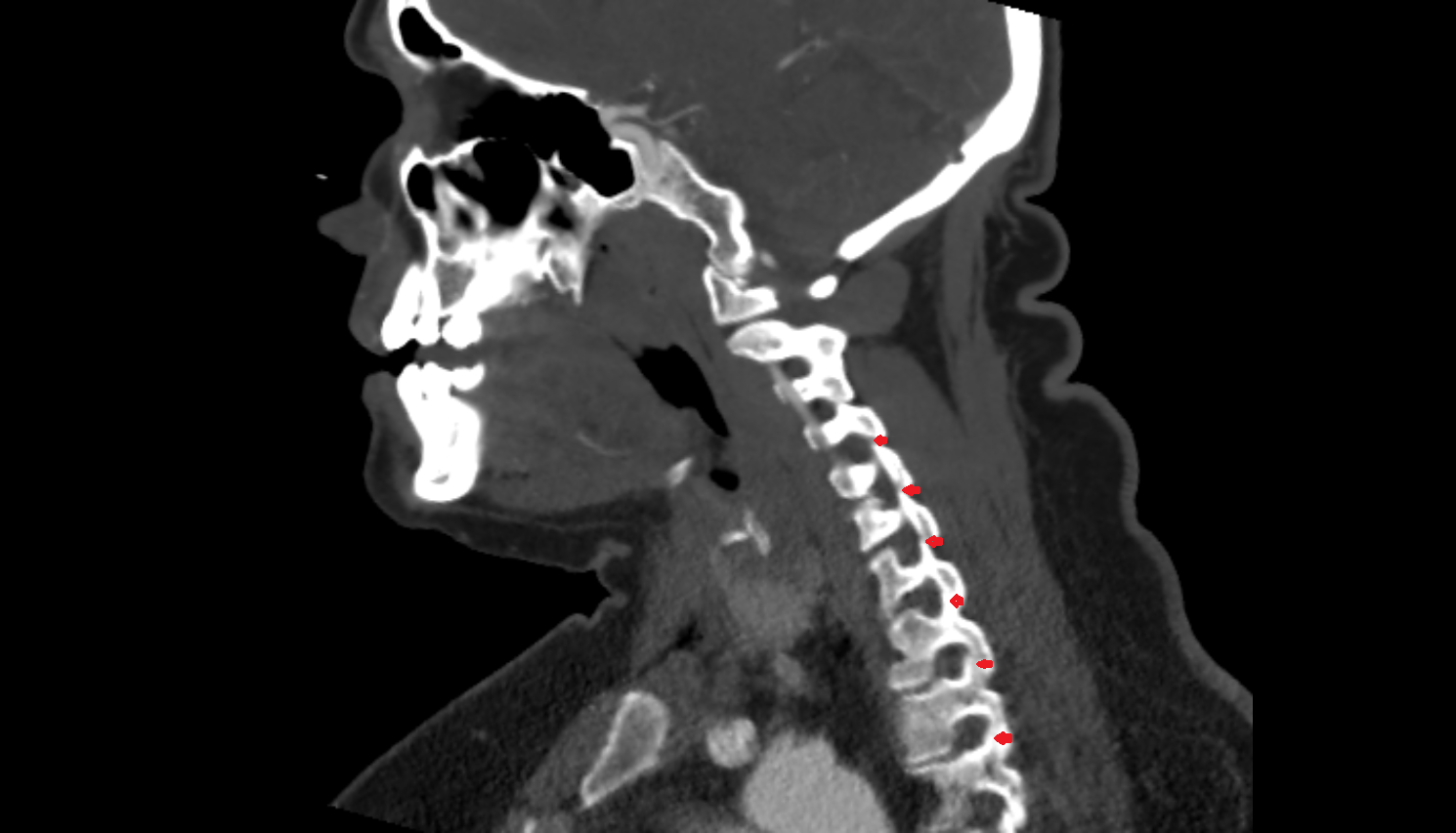 zygapophyseal joint of  vertebra , Location and Imaging Appearance  -img-00000-00000