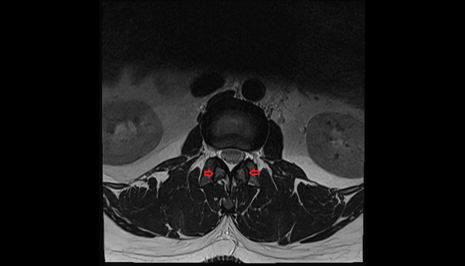 zygapophyseal joint of  vertebra , Location and Imaging Appearance  -img-00000-00000_00002
