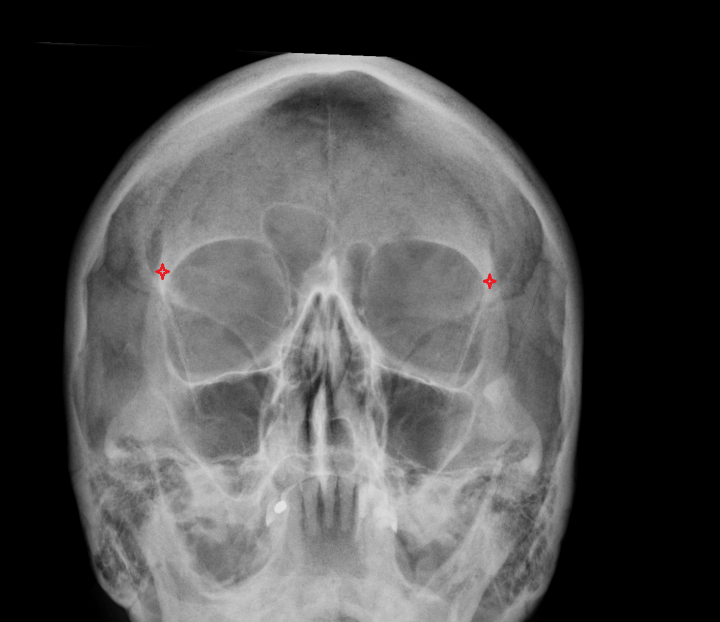 zygomatic process of frontal bone
